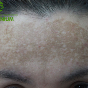 Prawdziwe przypadki: melasma na czole Prawdziwe przypadki: melasma na czole