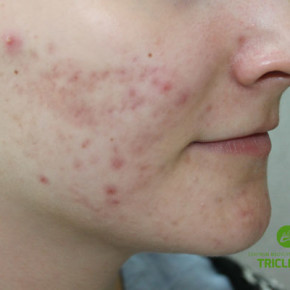 Aktywny trądzik – terapia (prawdziwe przypadki) Aktywny trądzik – terapia (prawdziwe przypadki)