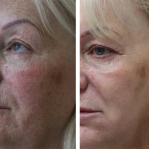 Laser frakcyjny ablacyjny na odmładzanie 60+ (prawdziwy przypadek) Laser frakcyjny ablacyjny na odmładzanie 60+ (prawdziwy przypadek)