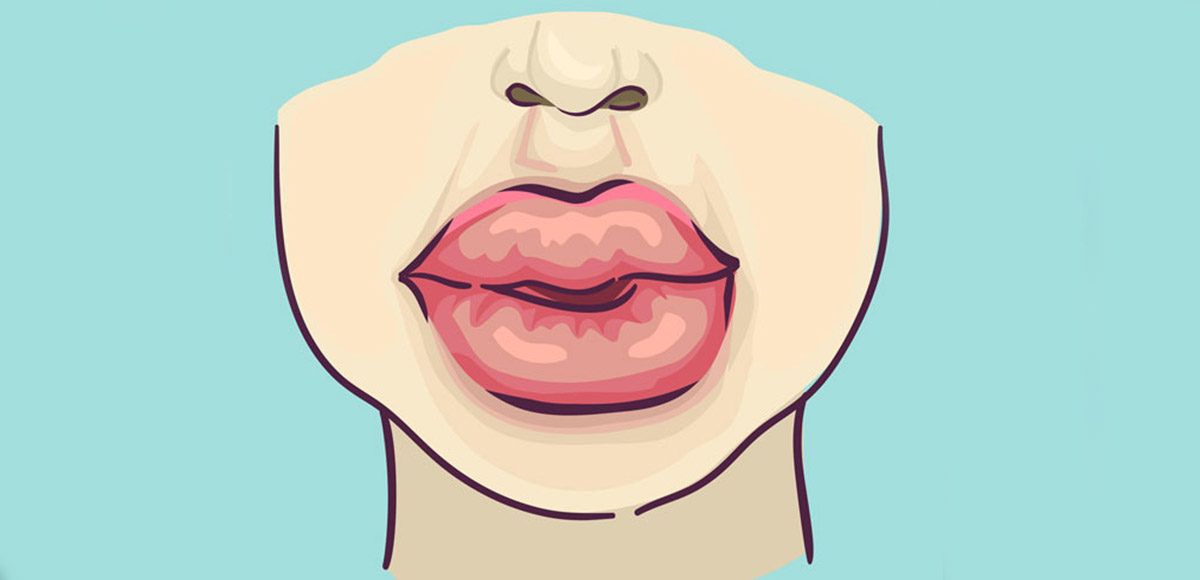 Uwaga na usta (nietypowa reakcja na kwas hialuronowy)