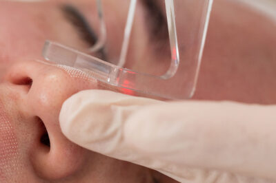 powikłania po laserze frakcyjnym