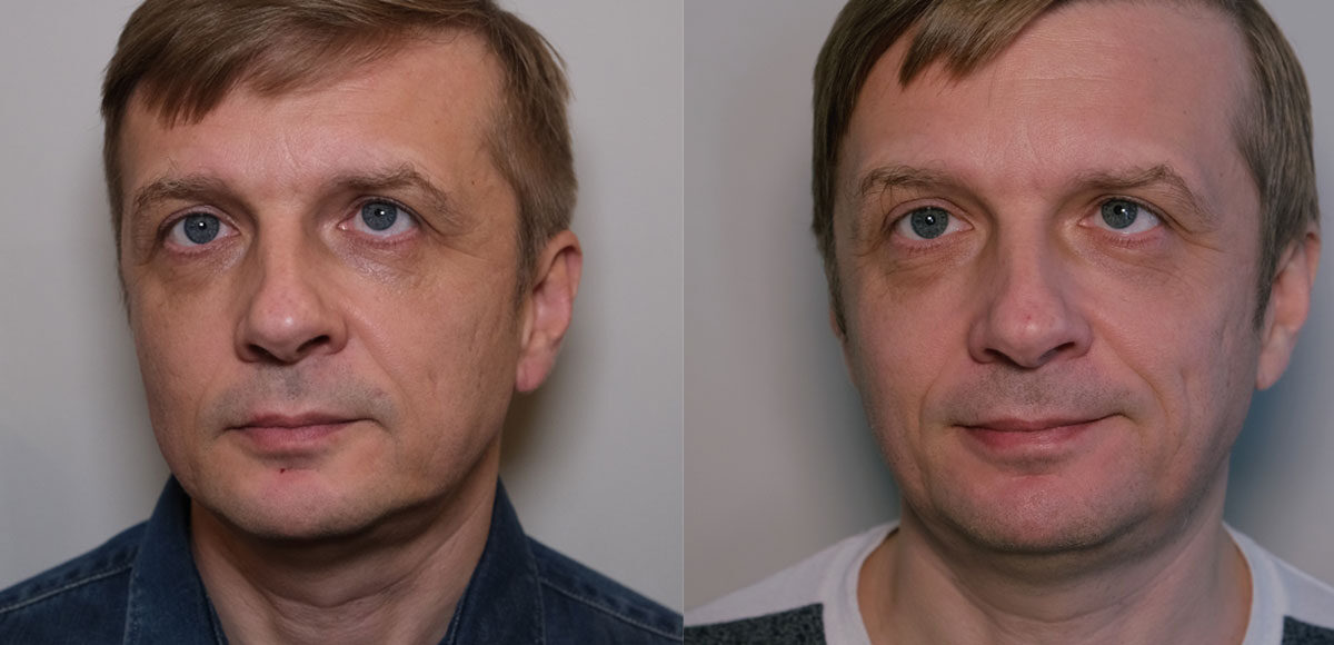 Quickly Arrow cheap Przetestowałem na sobie laser frakcyjny ablacyjny (efekty przed i po) - Dr  Marek Wasiluk MEDYCYNA ESTETYCZNA BEZ TAJEMNIC