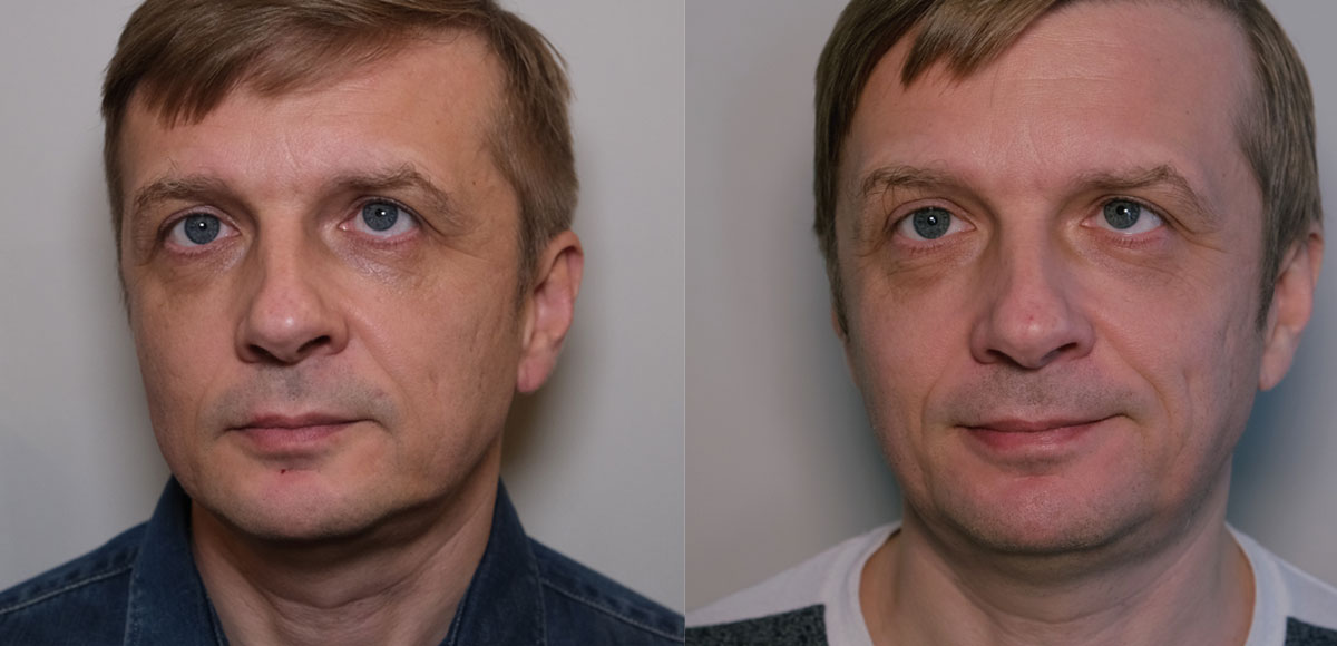 Prisoner desire lame Przetestowałem na sobie laser frakcyjny ablacyjny (efekty przed i po) - Dr  Marek Wasiluk MEDYCYNA ESTETYCZNA BEZ TAJEMNIC