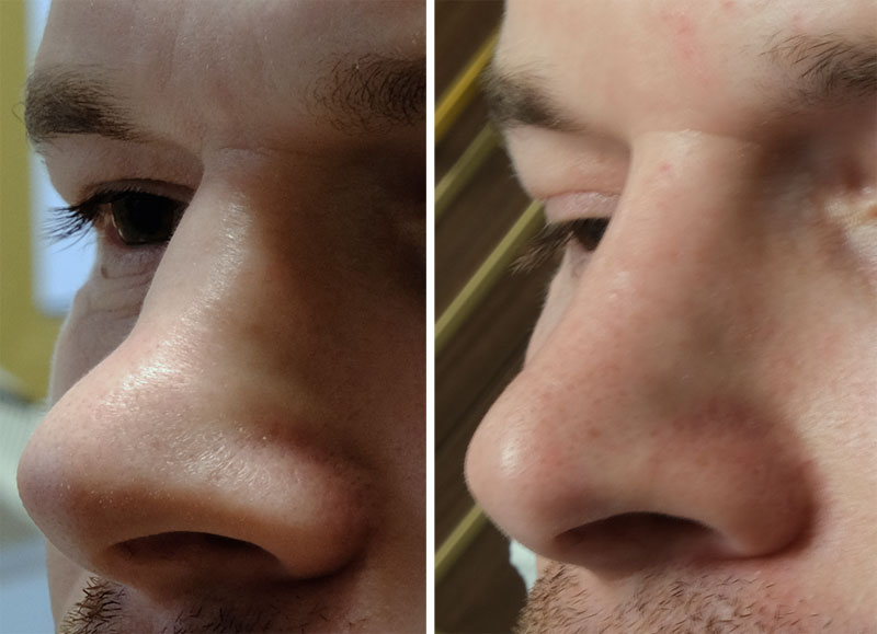 nos siodełkowaty przed i po zabiegu