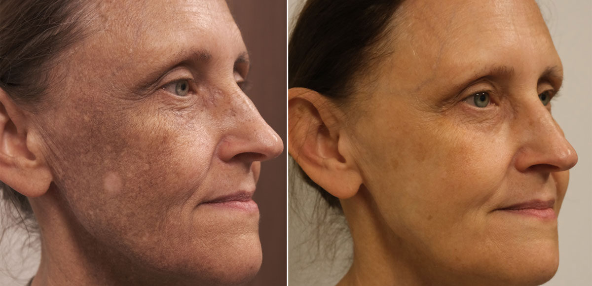 przebarwienia na twarzy