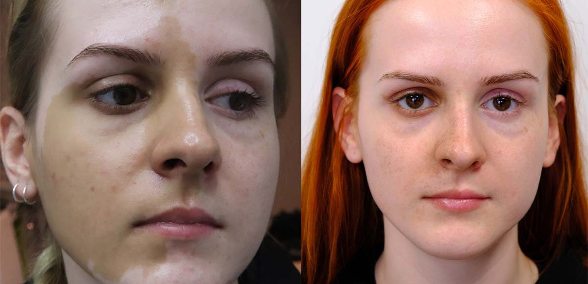 przebarwienie na pół twarzy, przed i po zabiegu