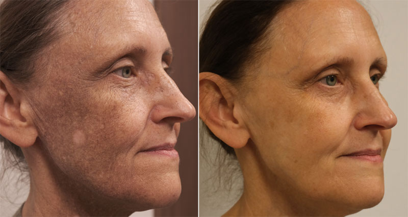 Przebarwienia, przed i po, fot. L'experta