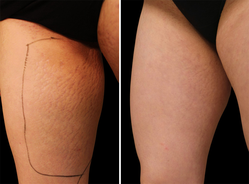 rf mikroigłowa, przed i o zabiegu