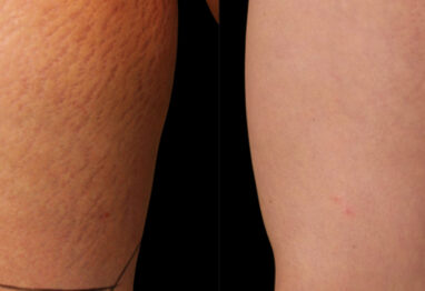 rozstępy - efekty przed i po