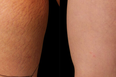 rozstępy - efekty przed i po